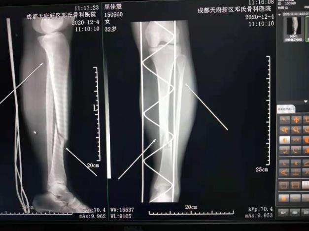 粉碎性骨折患者抗拒手術(shù)治療,感激鄧氏骨科成功治愈骨傷
