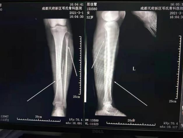 粉碎性骨折患者抗拒手術(shù)治療,感激鄧氏骨科成功治愈骨傷