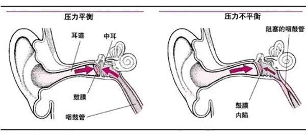 為什么感冒容易引起中耳炎?這些知識(shí)點(diǎn)你得了解!