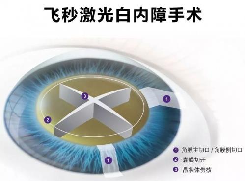 助力老年朋友暢享“睛”彩年華普瑞眼科舉辦關(guān)愛中老年眼健康公益活動