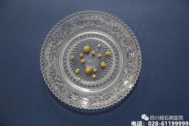四川結(jié)石病醫(yī)院突破難題為81歲老人取出十余枚黃色膽結(jié)石