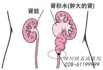 四川結(jié)石病醫(yī)院辟謠:腎結(jié)石的江湖謠言,你信了幾個?