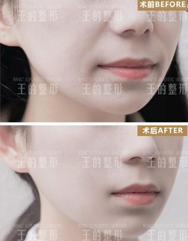 王的整形王海木院長告訴你:不同年齡段如何應對皮膚衰老?
