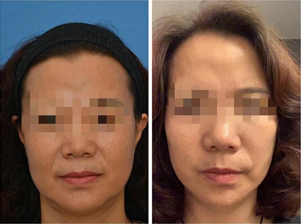 王的整形王海木院長告訴你:不同年齡段如何應對皮膚衰老?