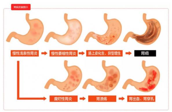 呼市東大肛腸醫(yī)院 出現(xiàn)這7個征兆,要警惕胃癌!