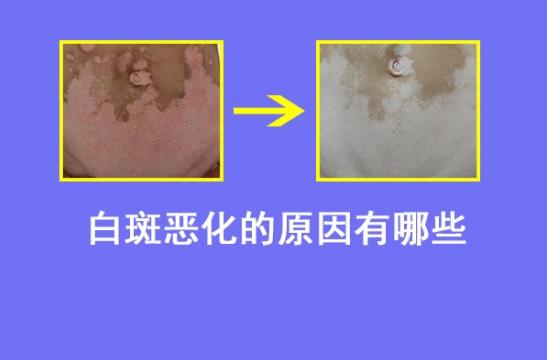 白癜風醫(yī)生林華:導致白癜風病情惡化的原因有哪些