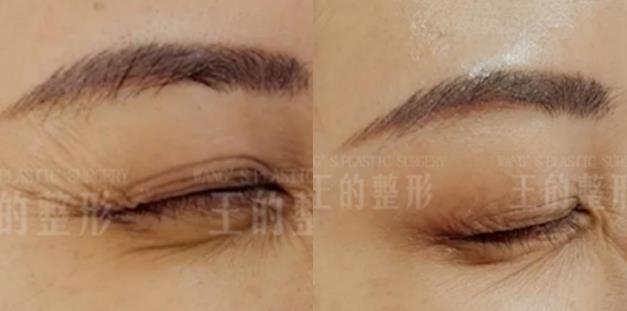 王的整形王海木教你:搞定魚尾紋,用這幾招妥妥了!