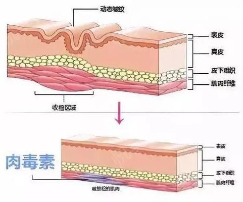王的整形王海木教你:搞定魚尾紋,用這幾招妥妥了!