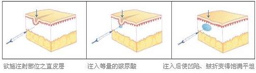 王的整形王海木教你:搞定魚尾紋,用這幾招妥妥了!