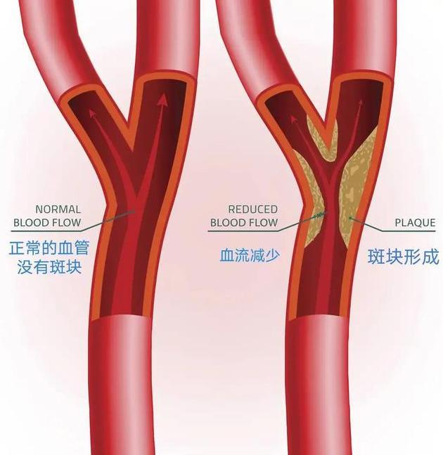 明醫(yī)方中醫(yī)藥治療頸動脈斑塊【三劑療法】