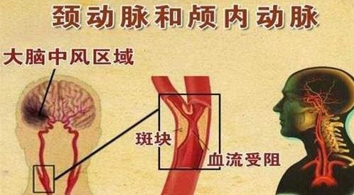 明醫(yī)方中醫(yī)藥治療頸動脈斑塊【三劑療法】