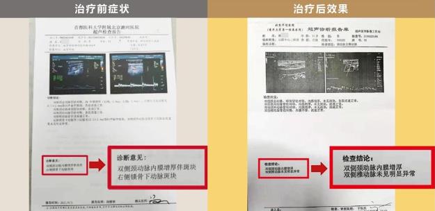 明醫(yī)方中醫(yī)藥治療頸動脈斑塊【三劑療法】
