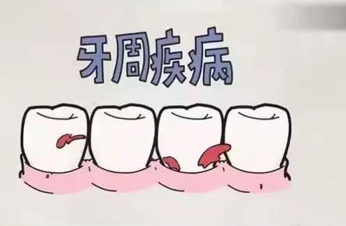 牙醫(yī)告訴你:洗牙如洗碗 真的不傷牙!