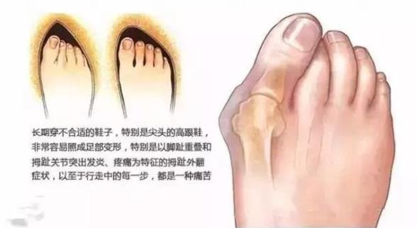 上海健橋醫(yī)院拇外翻侯明主任:腳骨拐突出手術多少錢