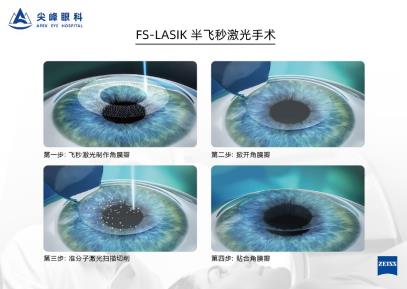 鄭州尖峰眼科:近視怎么通過參軍體檢?你可以試試這個辦法