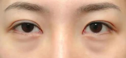 早睡、按摩、冰敷都不管用?健麗醫(yī)美幫你輕松去眼袋!