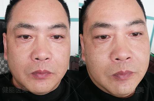 早睡、按摩、冰敷都不管用?健麗醫(yī)美幫你輕松去眼袋!