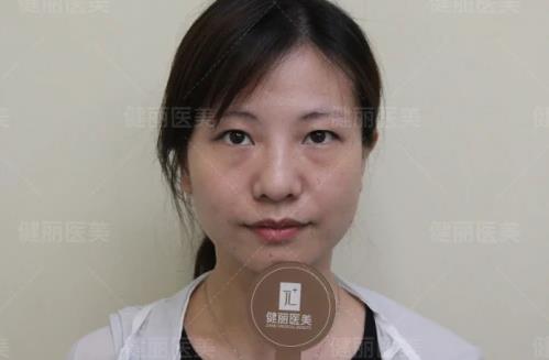 早睡、按摩、冰敷都不管用?健麗醫(yī)美幫你輕松去眼袋!