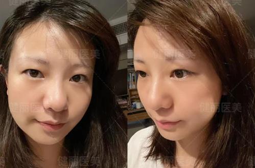 早睡、按摩、冰敷都不管用?健麗醫(yī)美幫你輕松去眼袋!