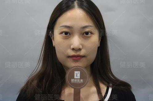早睡、按摩、冰敷都不管用?健麗醫(yī)美幫你輕松去眼袋!