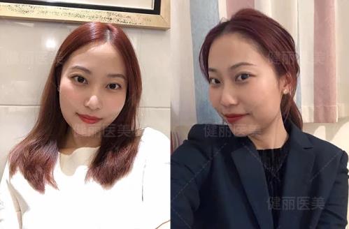 早睡、按摩、冰敷都不管用?健麗醫(yī)美幫你輕松去眼袋!
