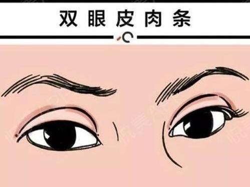 Do了雙眼皮后“肉條”明顯?王海木院長給你支招