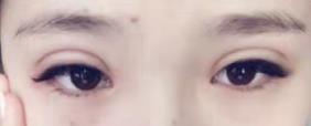 Do了雙眼皮后“肉條”明顯?王海木院長給你支招