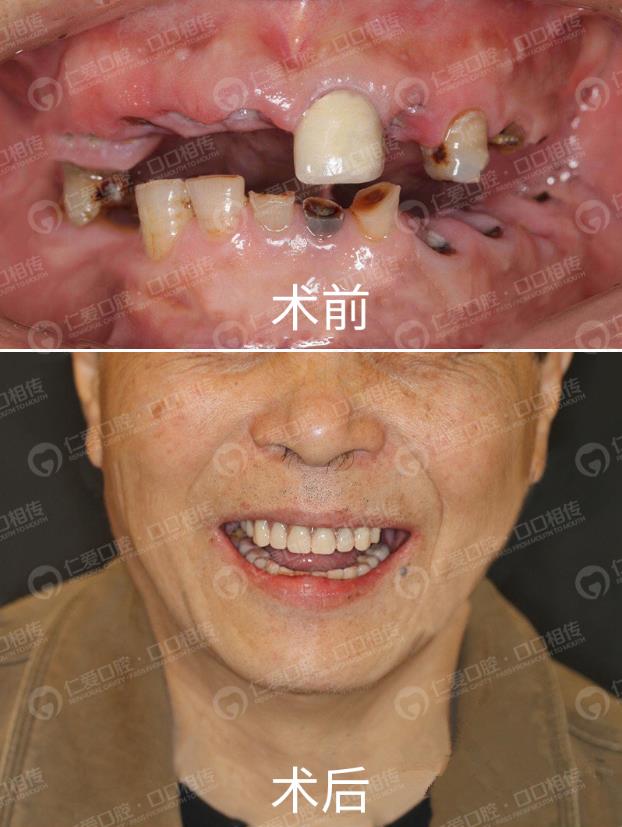 武漢仁愛(ài)口腔怎么樣,種植牙醫(yī)生及隱形矯正案例