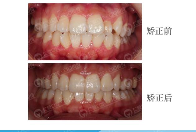 武漢仁愛(ài)口腔怎么樣,種植牙醫(yī)生及隱形矯正案例