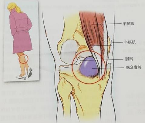 小腿吸脂為何是難點(diǎn)?廣州高尚形體雕塑來解疑