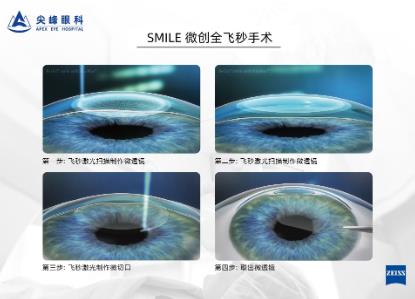 鄭州尖參軍體檢如何通過?你可以試試這個辦法——鄭州尖峰眼科