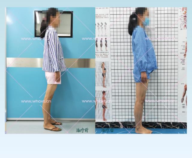 綁腿可以矯正O型腿嗎?武漢中陽醫(yī)院四維矯形技術(shù)七天矯正腿型異常