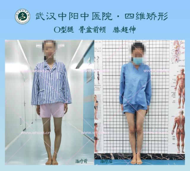 綁腿可以矯正O型腿嗎?武漢中陽醫(yī)院四維矯形技術(shù)七天矯正腿型異常