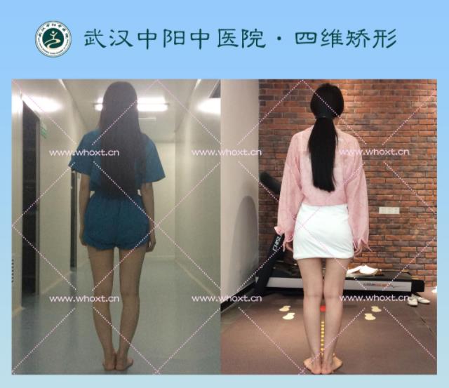 綁腿可以矯正O型腿嗎?武漢中陽醫(yī)院四維矯形技術(shù)七天矯正腿型異常