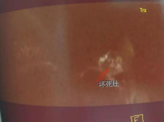 襄樊腫瘤醫(yī)院請選擇廣州復(fù)大醫(yī)院:冷凍治療保住乳腺癌患者的乳房