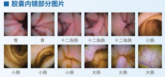 呼和浩特市東大肛腸醫(yī)院 胃里為什么會長息肉?日常如何預防胃息肉