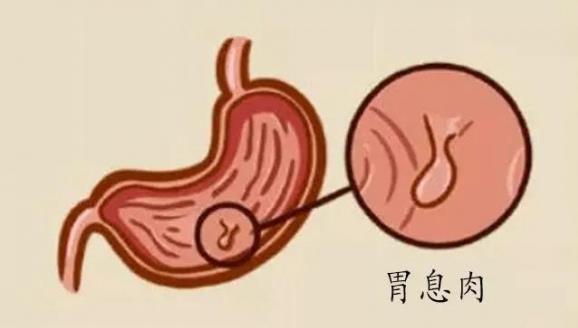 呼和浩特市東大肛腸醫(yī)院 胃里為什么會長息肉?日常如何預防胃息肉