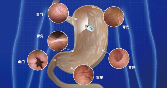 呼和浩特市東大肛腸醫(yī)院 胃里為什么會長息肉?日常如何預防胃息肉