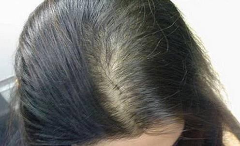 親身經歷分享:折磨我4年的產后脫發(fā),被穴位生發(fā)方治愈