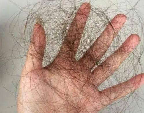 親身經歷分享:折磨我4年的產后脫發(fā),被穴位生發(fā)方治愈