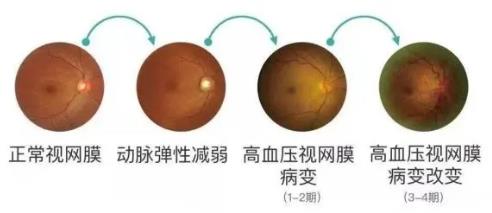 眼病精準(zhǔn)診斷再升級!鄭州尖峰眼科引進(jìn)蔡司CLARUS 500真彩超廣角眼底相機(jī)
