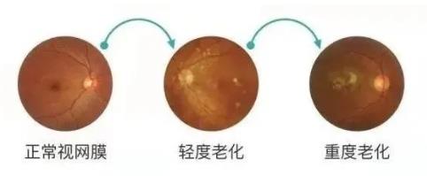 眼病精準(zhǔn)診斷再升級!鄭州尖峰眼科引進(jìn)蔡司CLARUS 500真彩超廣角眼底相機(jī)
