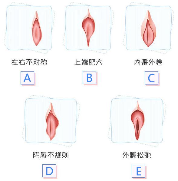 重慶小陰唇肥大哪家私密整形醫(yī)院做得好?