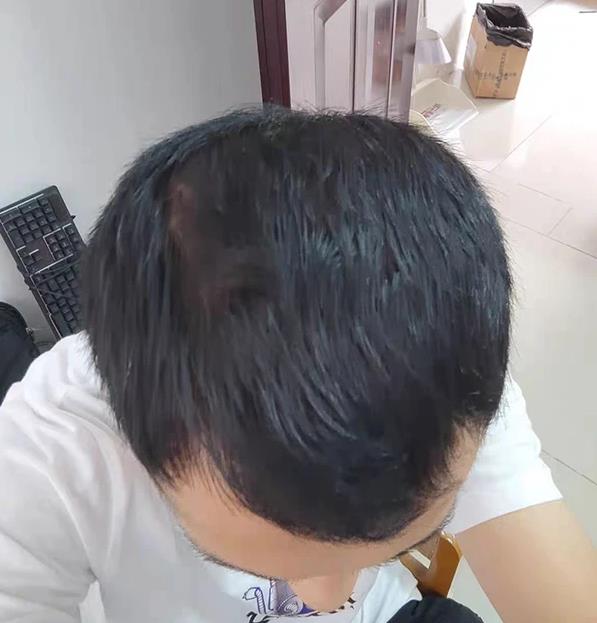 治療脫發(fā)|米諾地爾為什么能治療脫發(fā)?