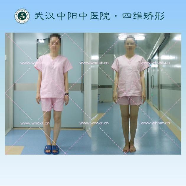 O型腿如何矯正?武漢中陽(yáng)中醫(yī)院四維矯形技術(shù)七天無(wú)痕矯正腿型