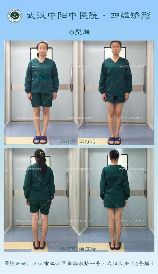 O型腿如何矯正?武漢中陽(yáng)中醫(yī)院四維矯形技術(shù)七天無(wú)痕矯正腿型