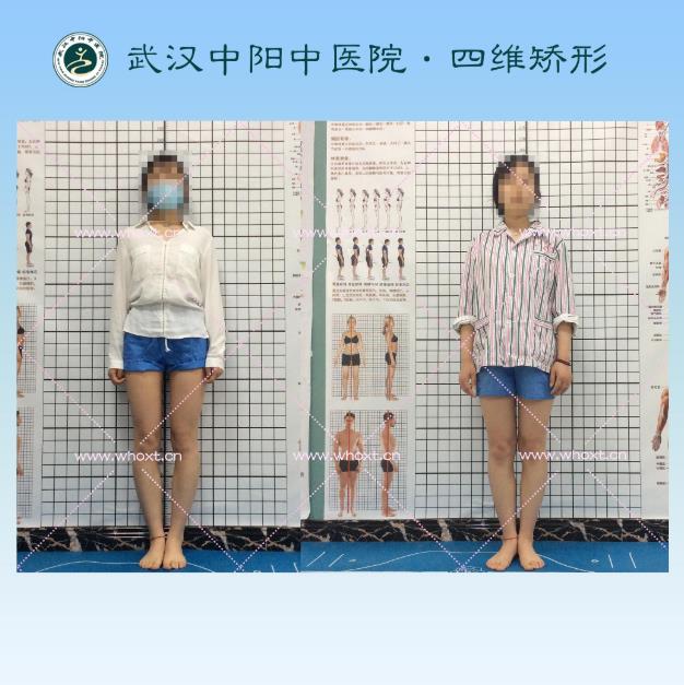 O型腿如何矯正?武漢中陽(yáng)中醫(yī)院四維矯形技術(shù)七天無(wú)痕矯正腿型