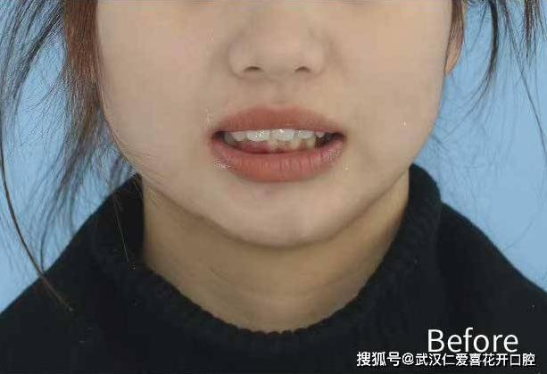武漢仁愛口腔牙齒不齊,嘴微凸?悄然變美的秘訣!