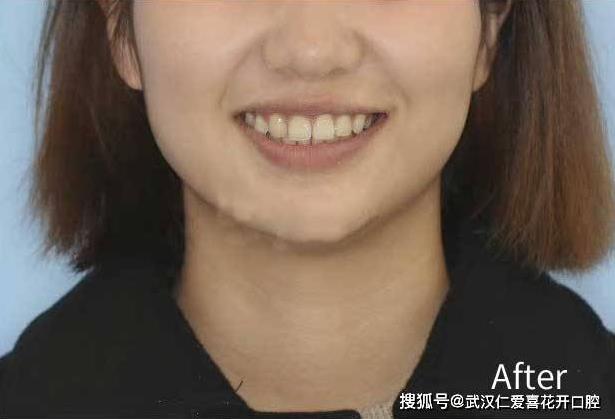 武漢仁愛口腔牙齒不齊,嘴微凸?悄然變美的秘訣!
