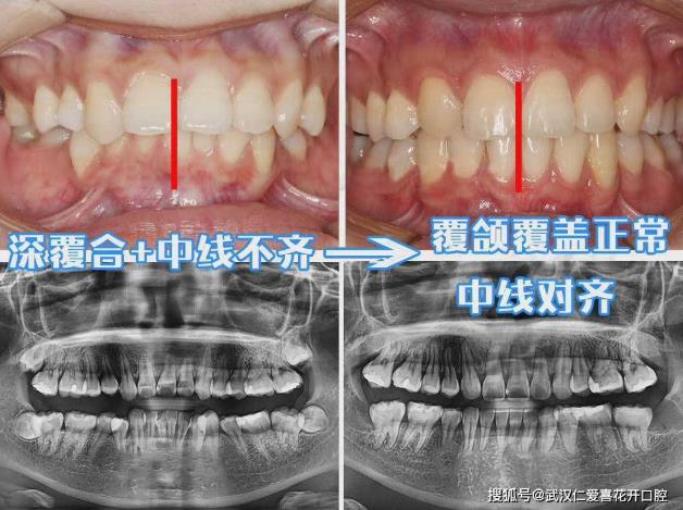 武漢仁愛口腔牙齒不齊,嘴微凸?悄然變美的秘訣!